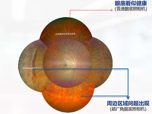 近视眼眼底问题示意图