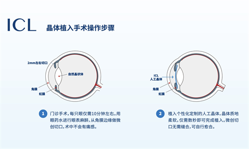 icl晶体植入术手术步骤示意图