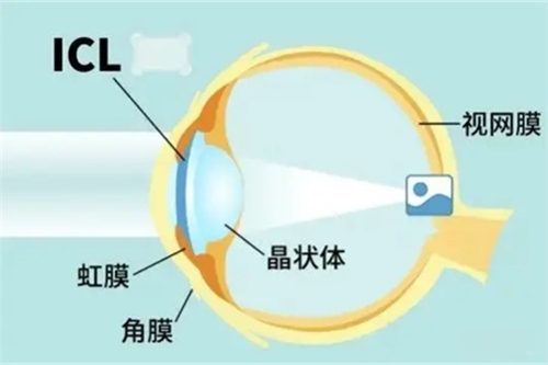 icl晶体植入术方式位置示意图