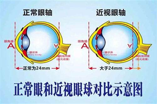 正常眼和近视眼球对比示意图