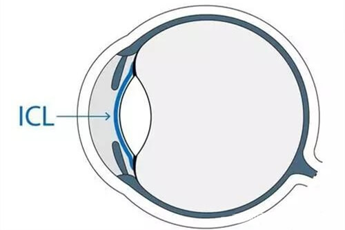 ICL晶体植入位置眼球示意图