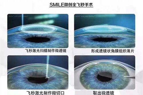 全飞秒手术过程图