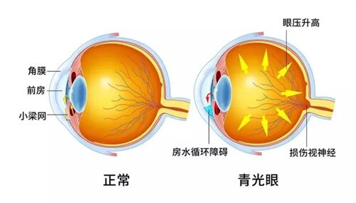 正常眼球和青光眼眼球对比