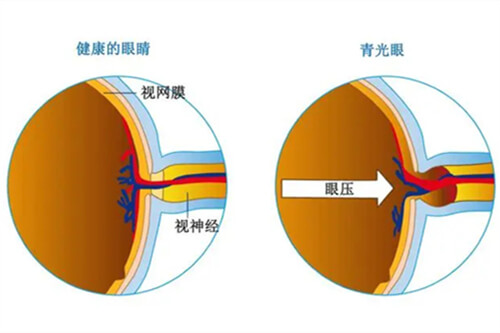 健康眼睛和青光眼眼压示意图