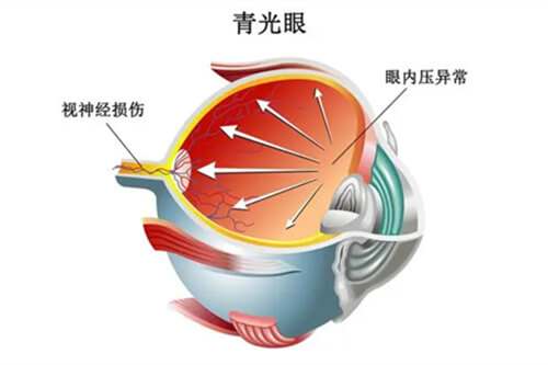 青光眼眼内压异常和视神经损伤漫画图