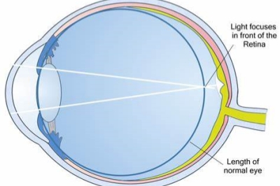 近视示意图
