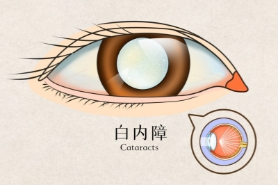 白内障示意图