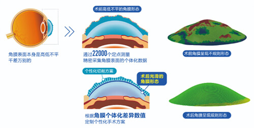 近视眼手术前后角膜变化示意图