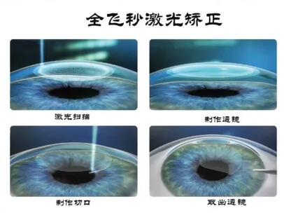 全飞秒激光矫正手术过程示意图