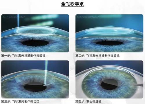 全飞秒手术过程图