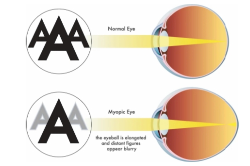 真性近视的成像示意图