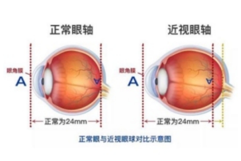 真性近视的眼轴对比示意图