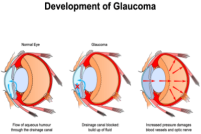 青光眼