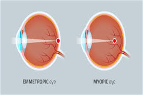 真性近视对比示意图