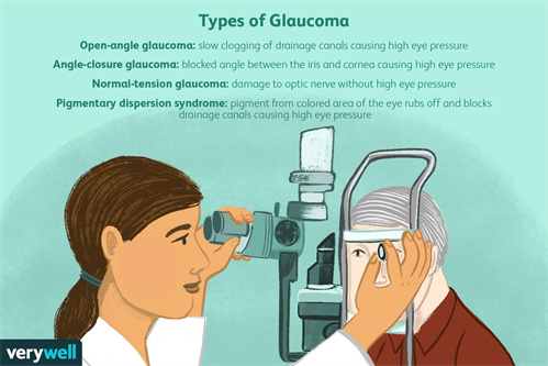 青光眼的类型示意图