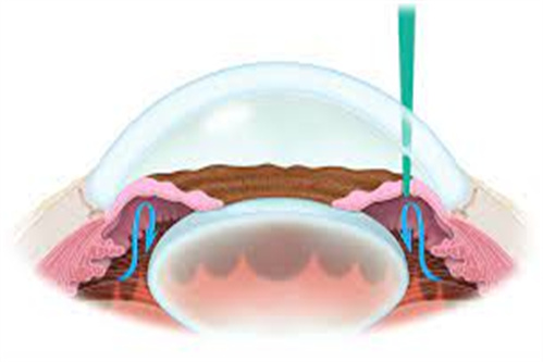 虹膜切除术示意图