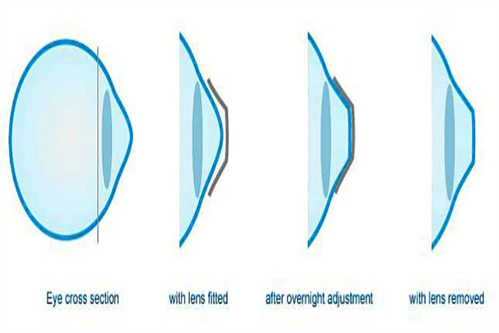 角膜塑形镜作用示意图