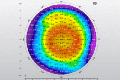 角膜地形图