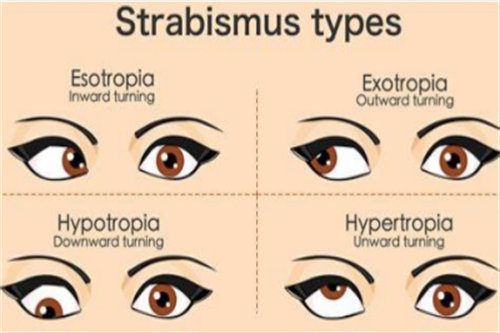 斜视的类型示意图