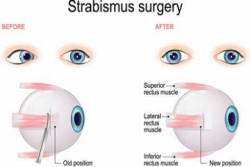 斜视与正常的眼睛对比