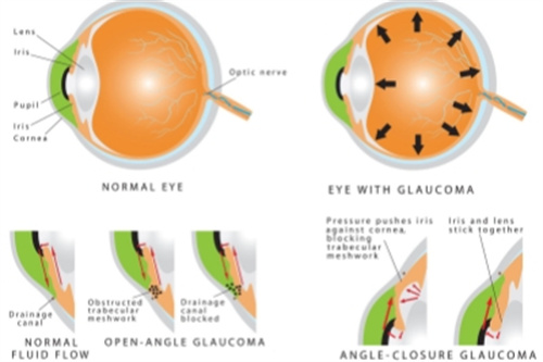 青光眼示意图