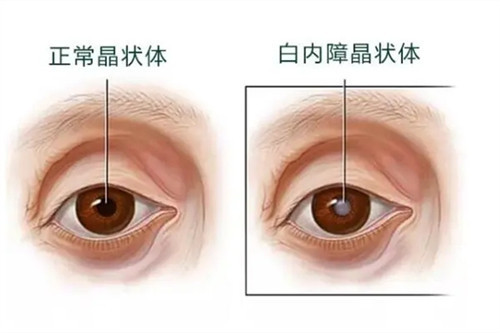 正常眼睛晶状体和白内障晶状体对比示意图