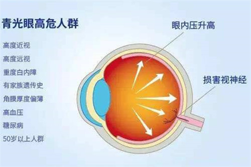 青光眼高位人群漫画图