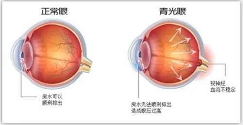 正常眼和青光眼对比图