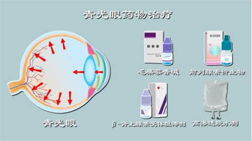 青光眼药物治疗示意图