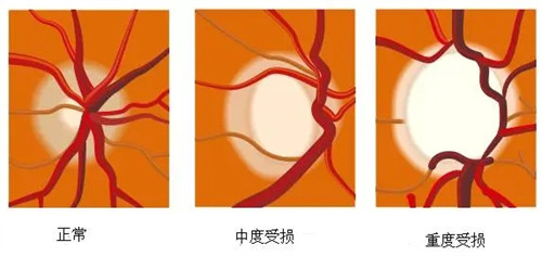 视神经受损的不同程度示意图