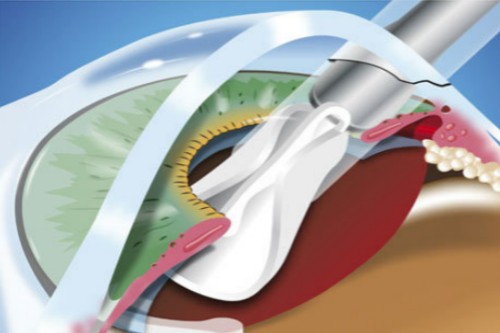 白内障手术示意图