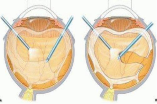 玻璃体切除术过程示意图