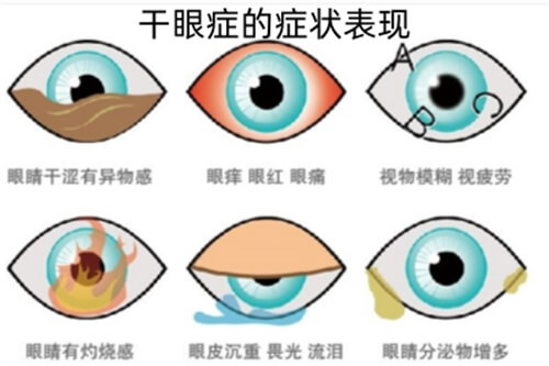 干眼症的症状及表现