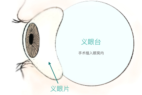 义眼片价格揭秘：从100元到15000元，你了解多少？