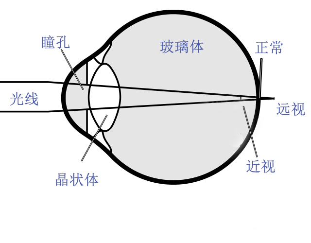 屈光不正远视近视图