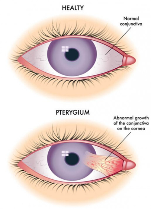 正常眼睛的翼状胬肉